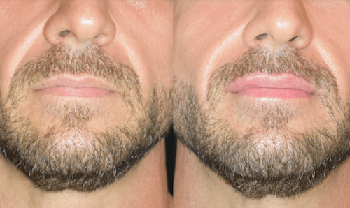 male Top Lip Fullness Filler Before After Oakville Lip Doctor
